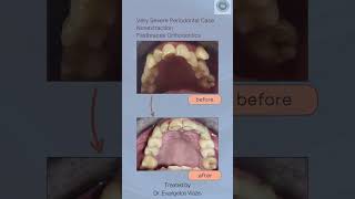 Orthodontics Fastbraces very severe periodontal case treated by Dr Evangelos Viazis 30092024 [upl. by Hooge]