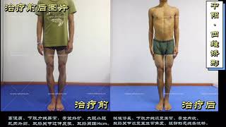 Bowed legs fix Simple bowed legs Chinese medicine correction [upl. by Derej287]