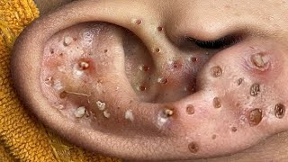 Big Cystic Acne Blackheads Extraction Blackheads amp Milia Whiteheads Removal Pimple Popping  8633 [upl. by Slack]