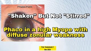 quotShakenquot but not quotStirredquot  Phaco in a High Myope with Diffuse Zonular Weakness Both Eyes Surgery [upl. by Minna]