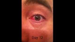 Pterygium Surgery and Recovery Daily Journal Pictures [upl. by Bailey862]