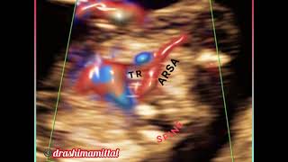 Aberrant right subclavian artery ARSA at 13 weeks fetal NT scan nuchal translucency [upl. by Ayanet]