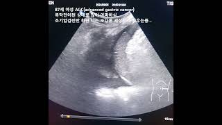 ascites amp pleural effusion복수흉수 [upl. by Neelon]