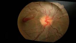 Yag Laser Hyaloidotomy for a pre macular haemorrhage [upl. by Nuarb]