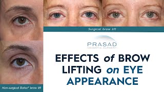 How Brow Lifting can Help with Eye Appearance and other Procedures to Open Up the Eyes [upl. by Cowey]