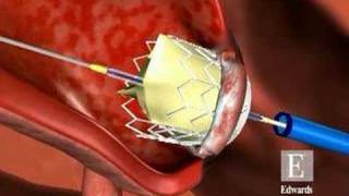 Vía transapical en el reemplazo de la válvula aórtica [upl. by Suivatnod]