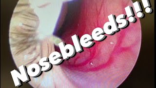 Nosebleeds epistaxis causes prevention treatments and more [upl. by Eirlav21]