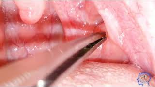 Tonsil Stone Removal procedure  Minor ENT Surgery Procedure tonsilstones mbbsskills medicoschool [upl. by Anurag13]