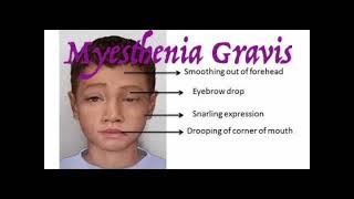 Myasthenia gravis mrcpch Clinical [upl. by Atival]