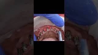 Soft bone maxilla full arch dental implants with intraoral welding post 6 months tapping test [upl. by Natanoy992]