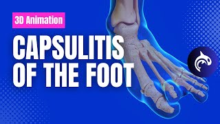 Capsulitis  Pain in the Ball of the Foot [upl. by Rotman9]