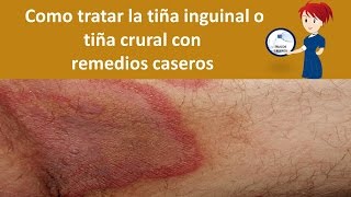 Como tratar la tiña inguinal o tiña crural con remedios caseros [upl. by Nehtiek]