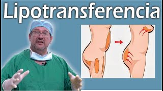 TODO SOBRE la LIPOTRANSFERENCIA 👙 transferencia a GLÚTEOS y MAMAS ❤️ El Dr ALBERTO CALVO RESPONDE [upl. by Eramal]