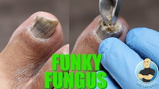 HAVE NAIL FUNGUS YOU NEED TO BE DOING THIS SUPER IMPORTANT TIP [upl. by Shena]