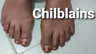 Red Swollen Itchy Toes  Chilblains [upl. by Mala]