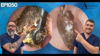 THICK EAR WAX PLUG REMOVED FROM PATIENTS EAR  EP1050 [upl. by Dusty]