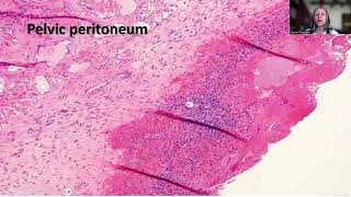 Tip141 Ovarian Cellular Fibroma with Extraovarian Deposits [upl. by Ytissac]