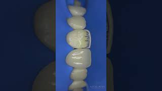 Composite restoration toothbuilup dentalcaries dentist dentalfillingorthodontist healthysmile [upl. by Singh848]