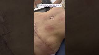 Cicatriz de una abdominoplastia  Dra lina Franco cirugiasplasticas [upl. by Mathews]