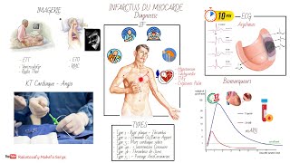 INFARCTUS DU MYOCARDE IDM  PHYSIOPATHOLOGIE ET DIAGNOSTIC [upl. by Rocca]