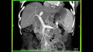 Abdomen Liver Cirrhosis 3D Volume rendering of a cirrhotic liver with collaterals [upl. by Holleran]