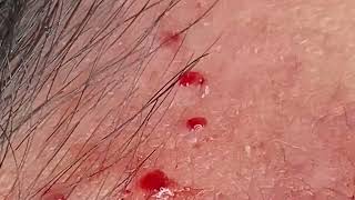 Effective Acne Scar Treatments for Smooth Skin Addressing Cystic Acne Fungal Acne and Hormonal Acn [upl. by Aleek378]