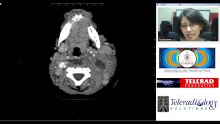 Retropharyngeal Abscess CT study by Dr Rekha Swamy [upl. by Laehcim587]