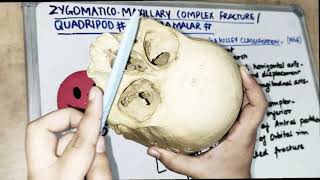 zmc zygomatic complex fracture lecture  classification [upl. by Ahsiat]