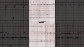 AVNRT ECG Regular and rapid rate [upl. by Clausen]