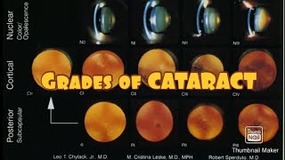 Grades of CATARACT 👀 [upl. by Pace]