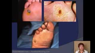 Corn amp Callus Debridement by a Podiatrist [upl. by Euhsoj]