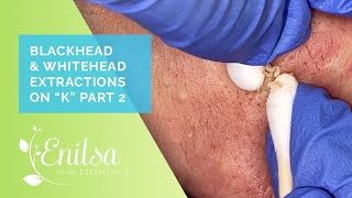 Blackhead amp Whitehead Extractions on quotKquot  Part 2 [upl. by Shanks]