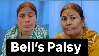 Bell’s Palsy Patient Review Recovery Dr Pritam Singh  Jigars physiotherapist [upl. by Akissej]