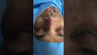 Male tip refining and lengthening nose job cosmetic plastic surgery [upl. by Vallery]