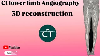 How did you make this  3D reconstruction ct lower limb angiography  Ge 32 resolution machine [upl. by Erny541]