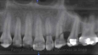 Tomografía de fracturas dentales  RXORAL 3D [upl. by Aseela564]