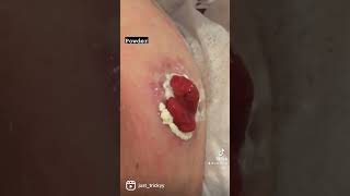 Stoma care ileostomy skin help [upl. by Leizo72]