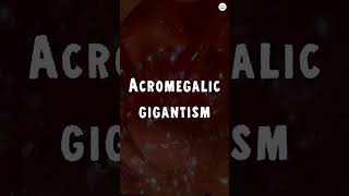 Acromegalic Gigantism How a Tumor Turns You Into a Giant [upl. by Fregger443]