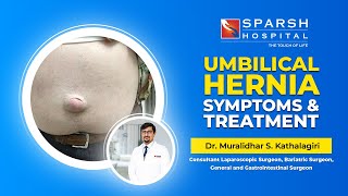 Umbilical Hernia  Symptoms amp Treatment  Dr Muralidhar S Kathalagiri  SPARSH Hospital [upl. by Thacker]