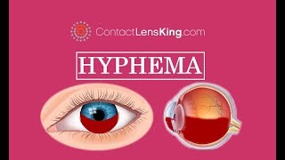 What is a Hyphema Blood Pooling in the Front of Eye [upl. by Charil]