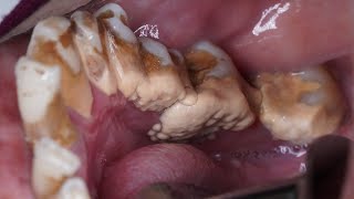 Deep Cleaning With HEAVY Tartar Build Up At The Dentist [upl. by Hiroshi]