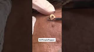 A Win is a Win Dr Pimple Popper ForeheadPop [upl. by Bickart]