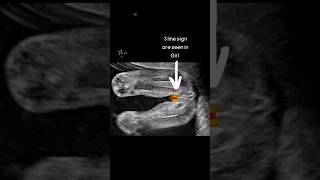 Ultrasound Scan Showing Baby Girl 👧 oldwivestales status pregnancy educational [upl. by Onitsuaf552]