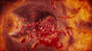 3D animation of a Clogged blood vessel due to a Sickle cell disease [upl. by Walt]