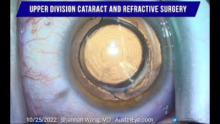 Intraocular lens exchange after YAG capsulotomy wplacement of Vivity lens inside the capsular bag [upl. by Eylrahc]