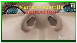 Rhinoplasty Animation  How can Wide Nostrils be Narrowed [upl. by Atok]