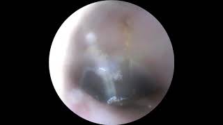 Visible eardrum Post antifungal otoscopy otoscope otolaryngology medicos [upl. by Latt]