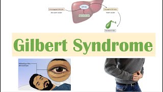 Gilbert Syndrome  Causes Genetics Pathogenesis Signs amp Symptoms Diagnosis Treatment [upl. by Silverts]