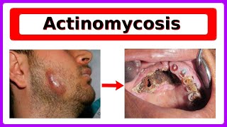 actinomycosis [upl. by Gwenora]