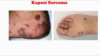 Kaposi sarcoma [upl. by Anjali832]